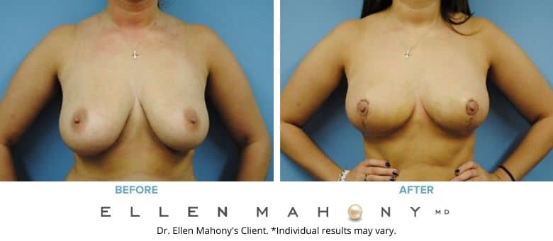 Before and After Image: Case #2613 - front