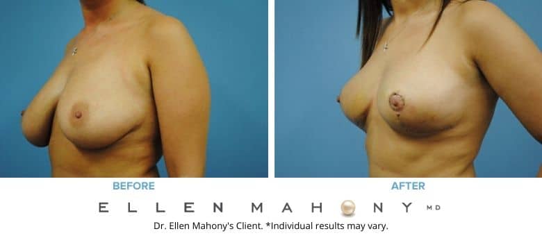 Before and After Image: Case #2613 - left-front-oblique