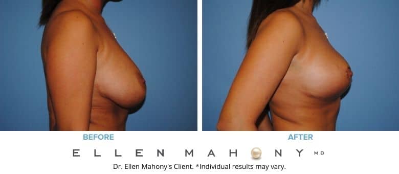 Before and After Image: Case #2613 - right-side