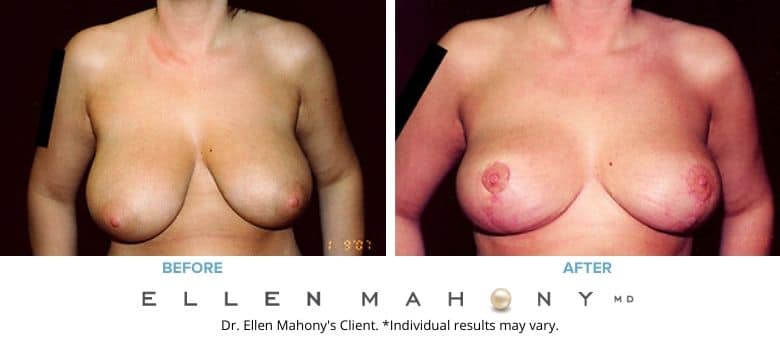 Before and After Image: Case #2643 - front