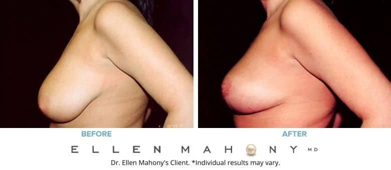 Before and After Image: Case #2643 - left-side