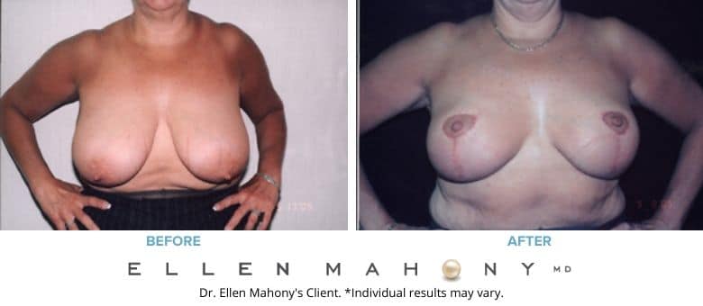Before and After Image: Case #2650 - front
