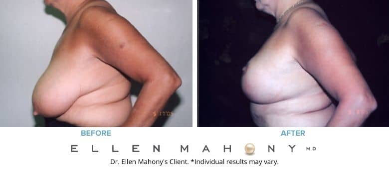 Before and After Image: Case #2650 - left-side