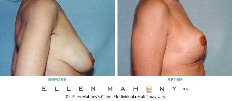Before and After Image: Case #2657 - right-side