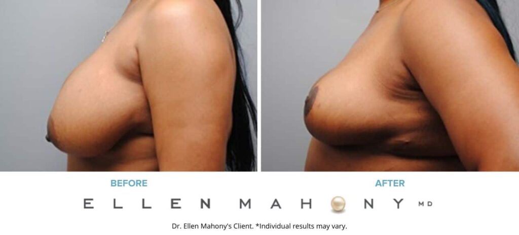 Before and After Image: Case #5190 - left-side