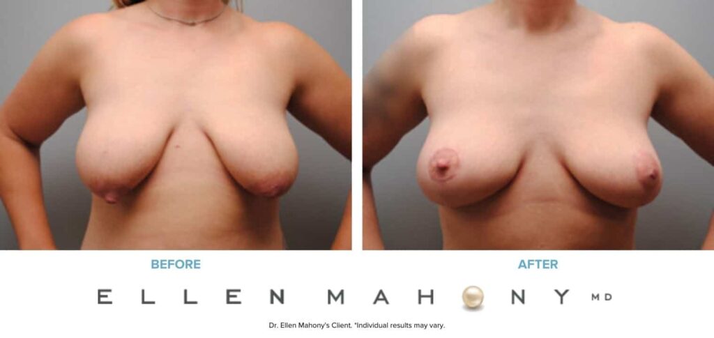 Before and After Image: Case #6172 - front