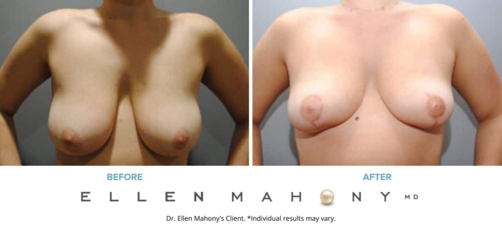 Before and After Image: Case #6244 - front