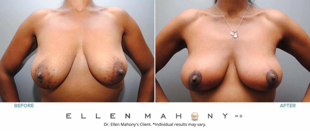 Before and After Image: Case #6448 - front