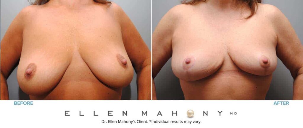 Before and After Image: Case #6734 - front