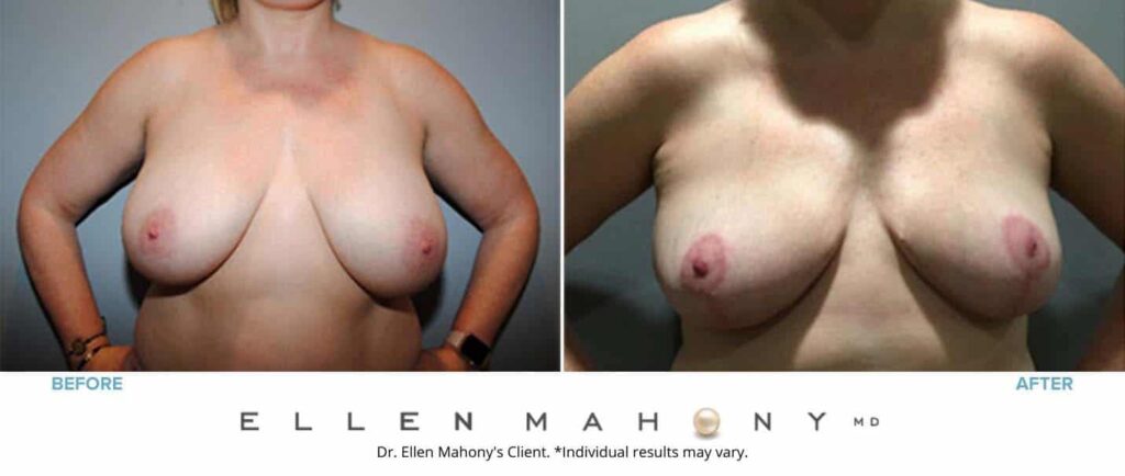 Before and After Image: Case #7214 - front