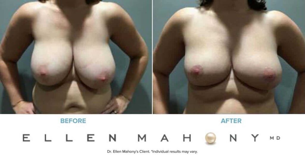 Before and After Image: Case #7346 - front