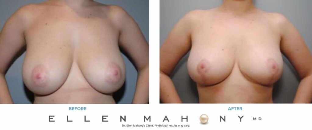 Before and After Image: Case #8281 - front