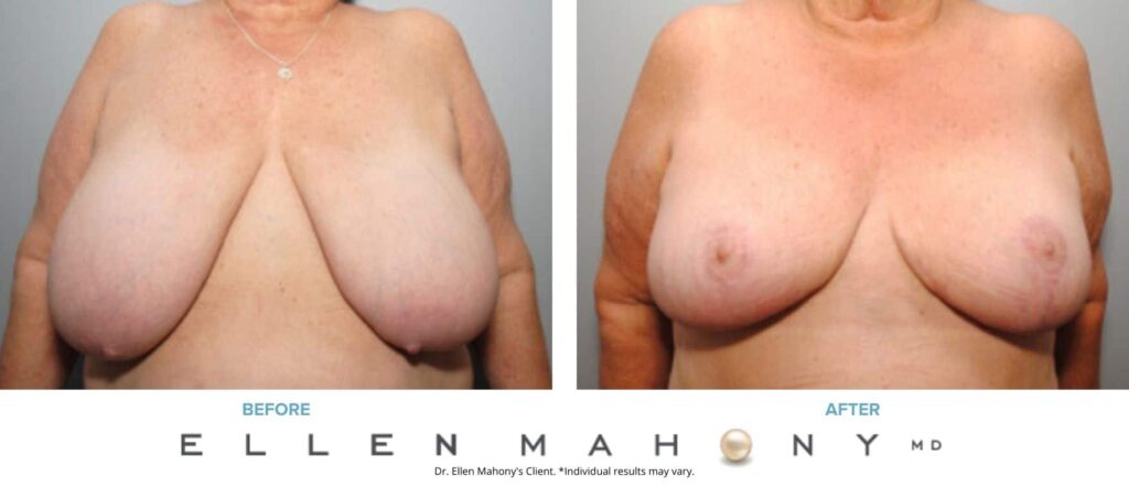 Before and After Image: Case #8348 - front