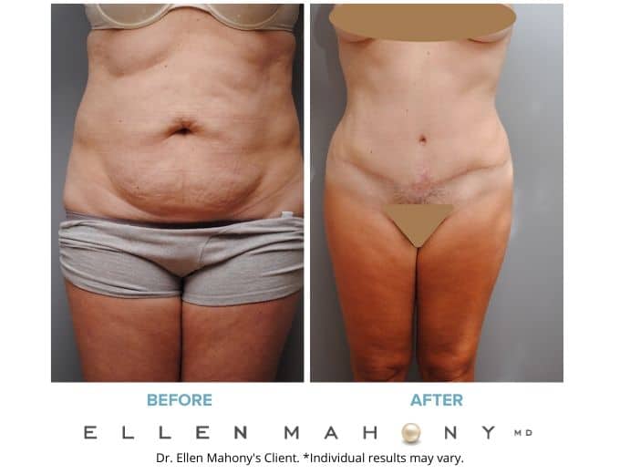 Before and After Image: Case #2098 - front