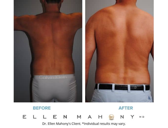 Before and After Image: Case #2107 - back
