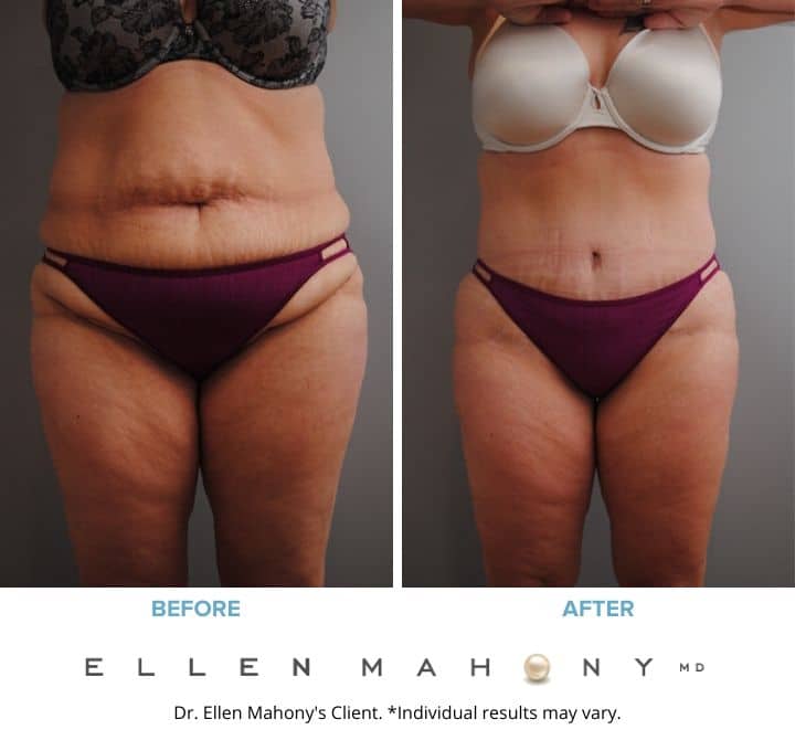 Before and After Image: Case #2113 - front