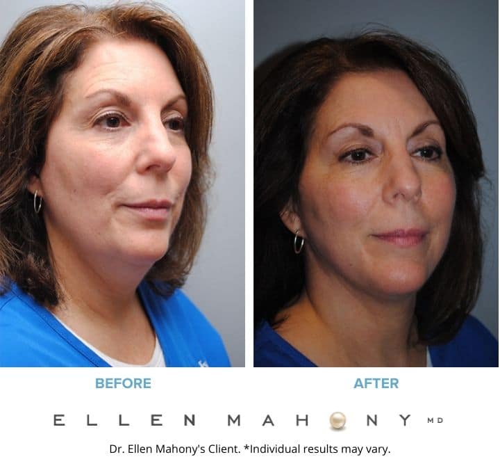 Before and After Image: Case #2127 - right-front-oblique
