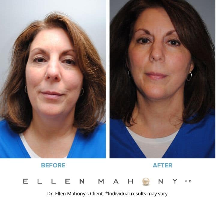 Before and After Image: Case #2127 - front