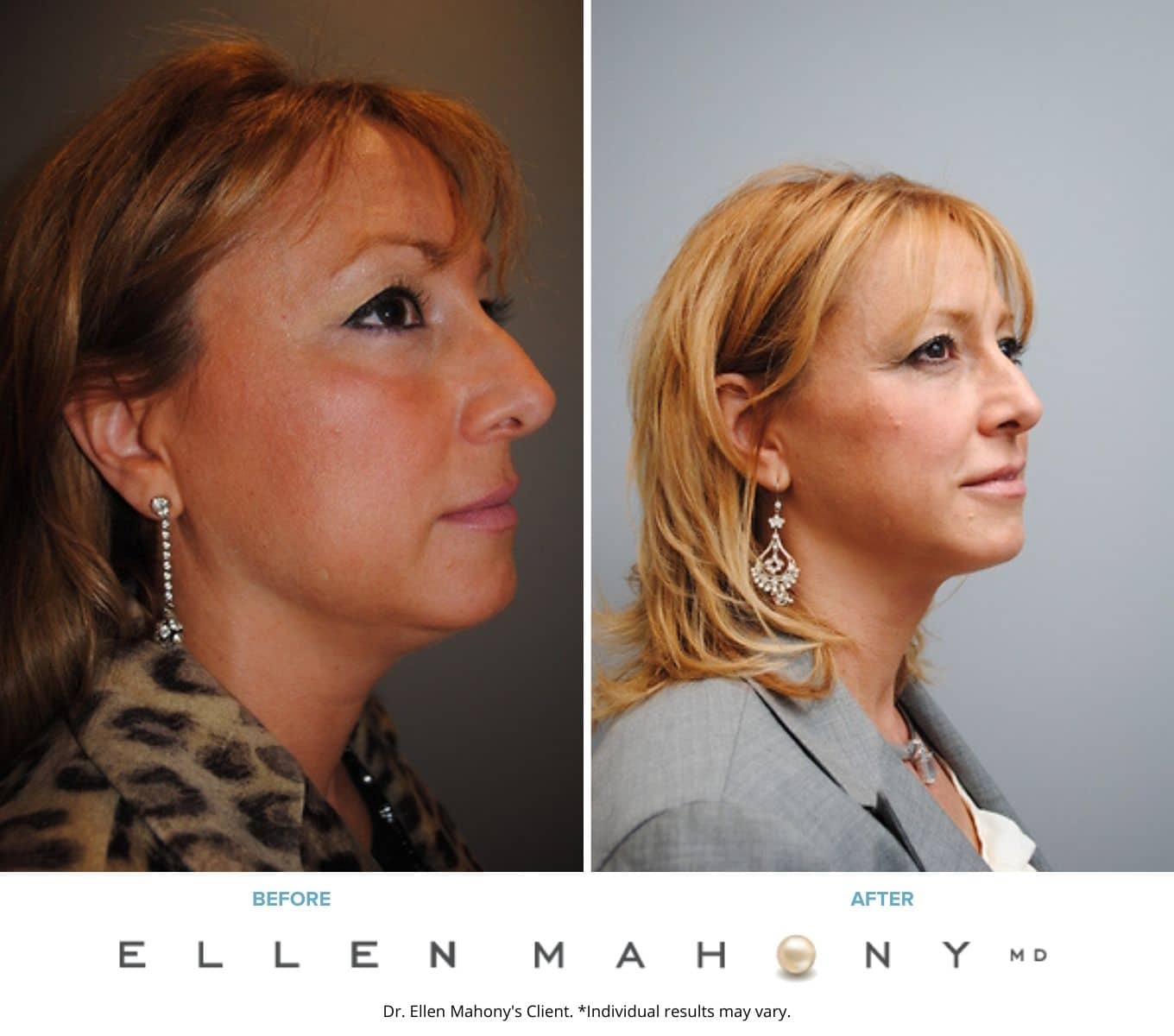 Before and After Image: Case #2149 - right-front-oblique
