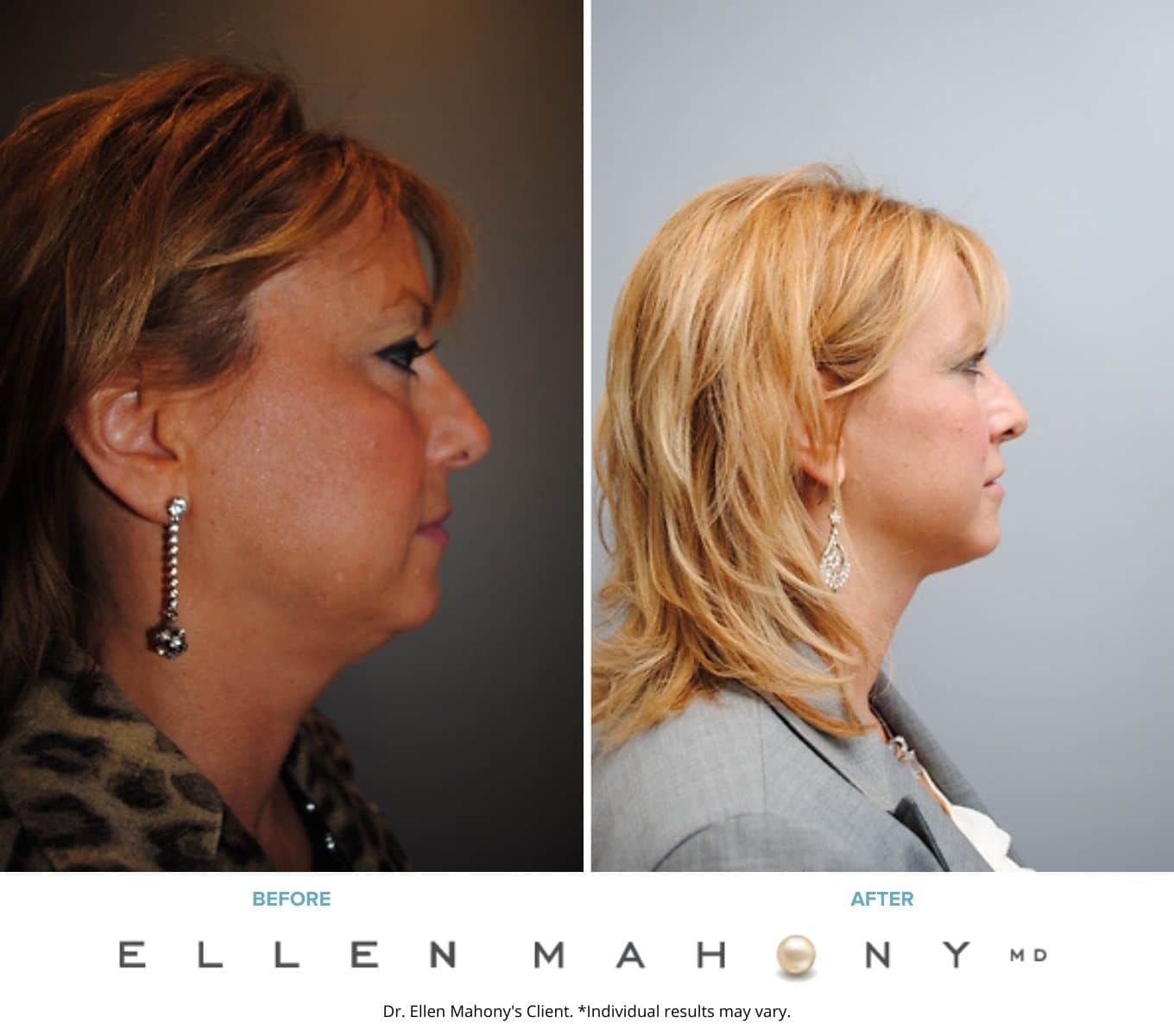 Before and After Image: Case #2149 - right-side