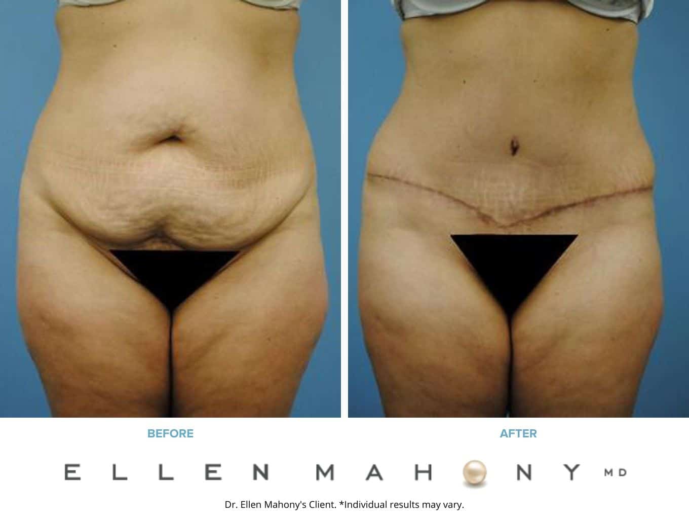 Before and After Image: Case #2293 - front