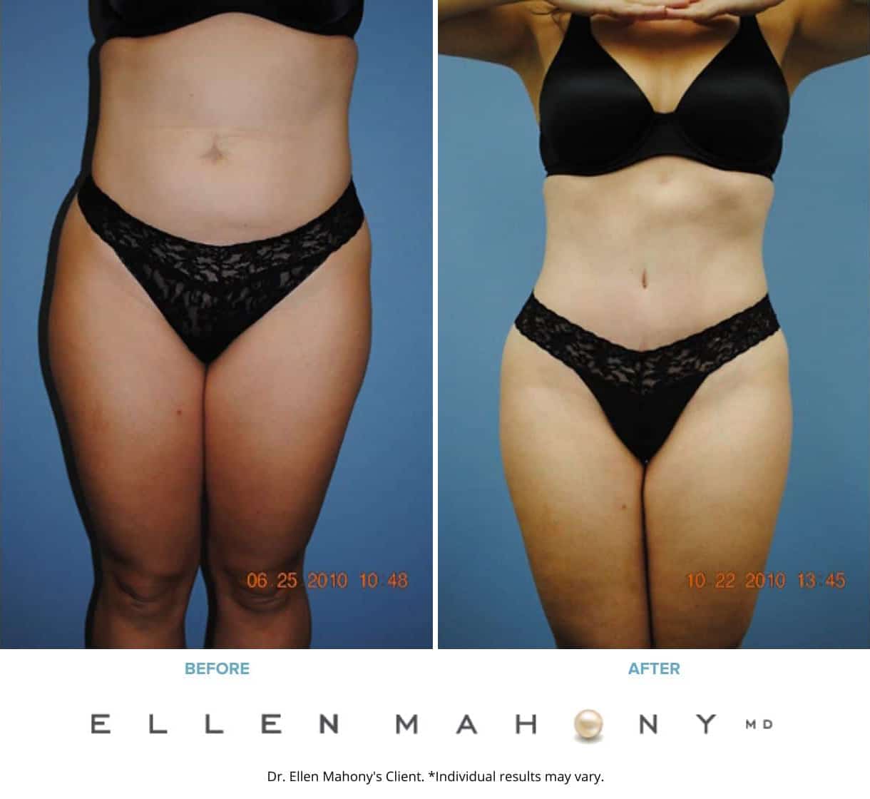 Before and After Image: Case #2317 - front