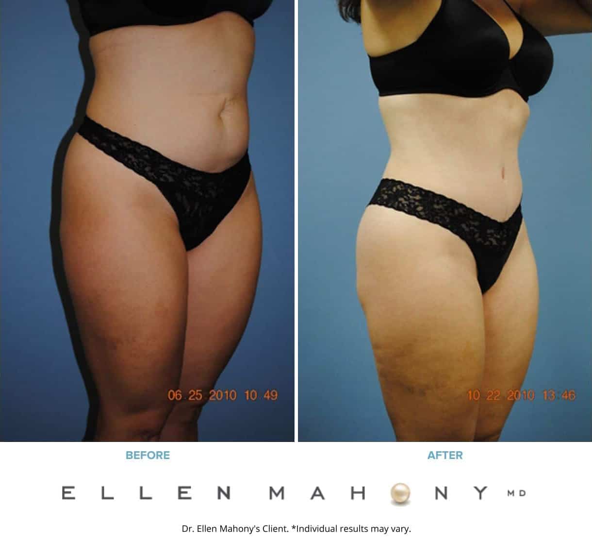Before and After Image: Case #2317 - right-front-oblique