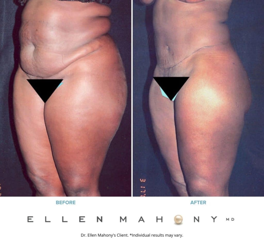 Before and After Image: Case #2342 – Extended Tummy Tuck - left-front-oblique