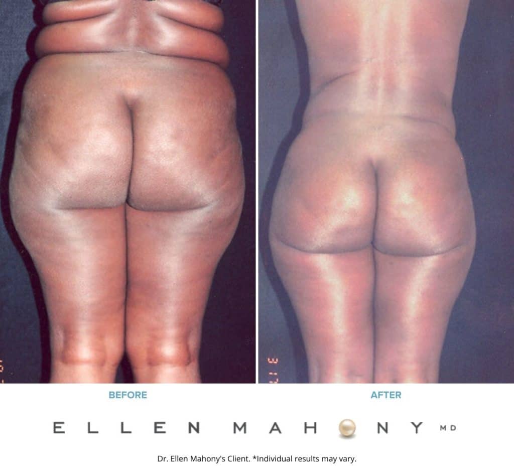 Before and After Image: Case #2342 – Extended Tummy Tuck - back