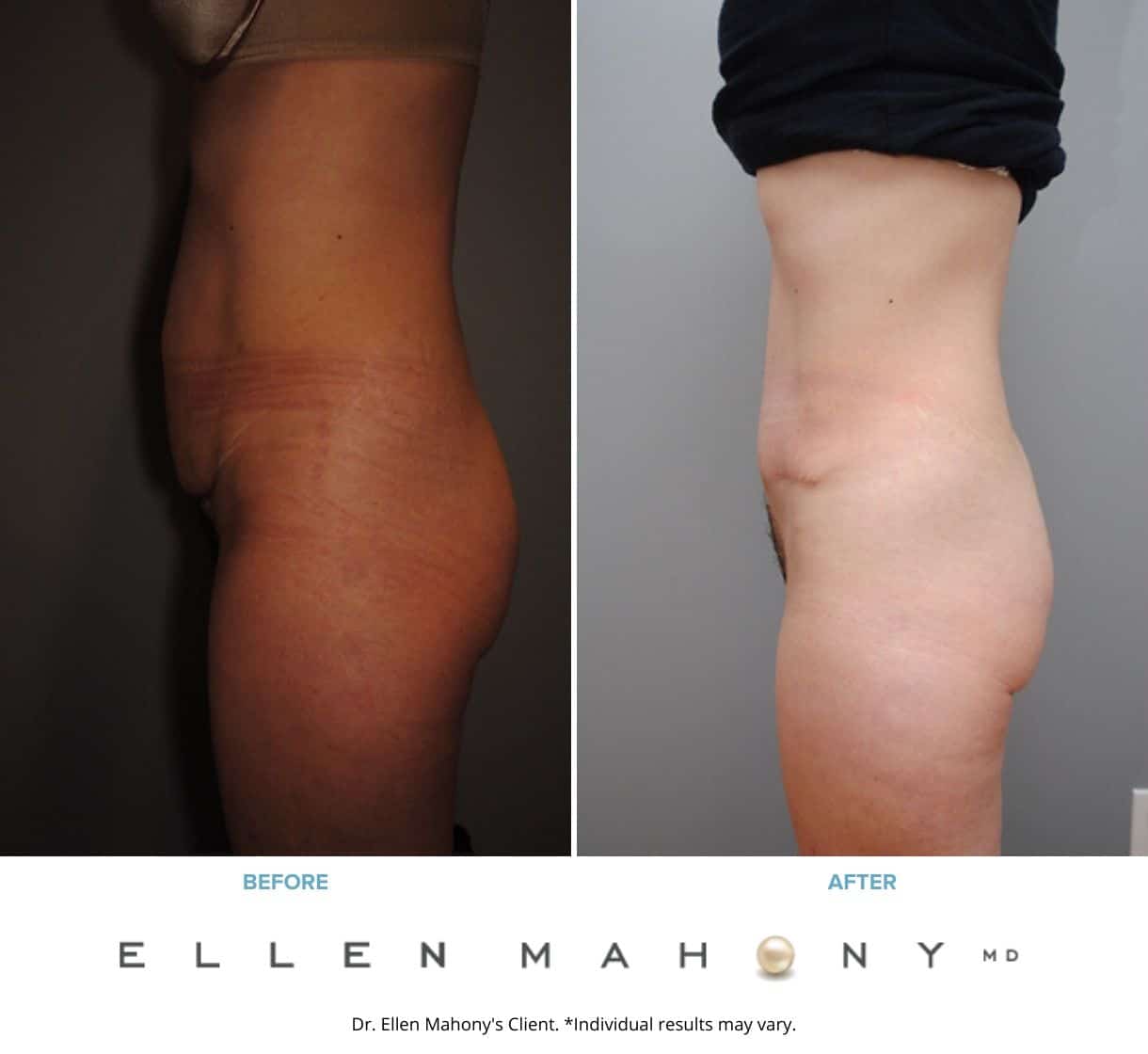 Before and After Image: Case #2393 - left-side