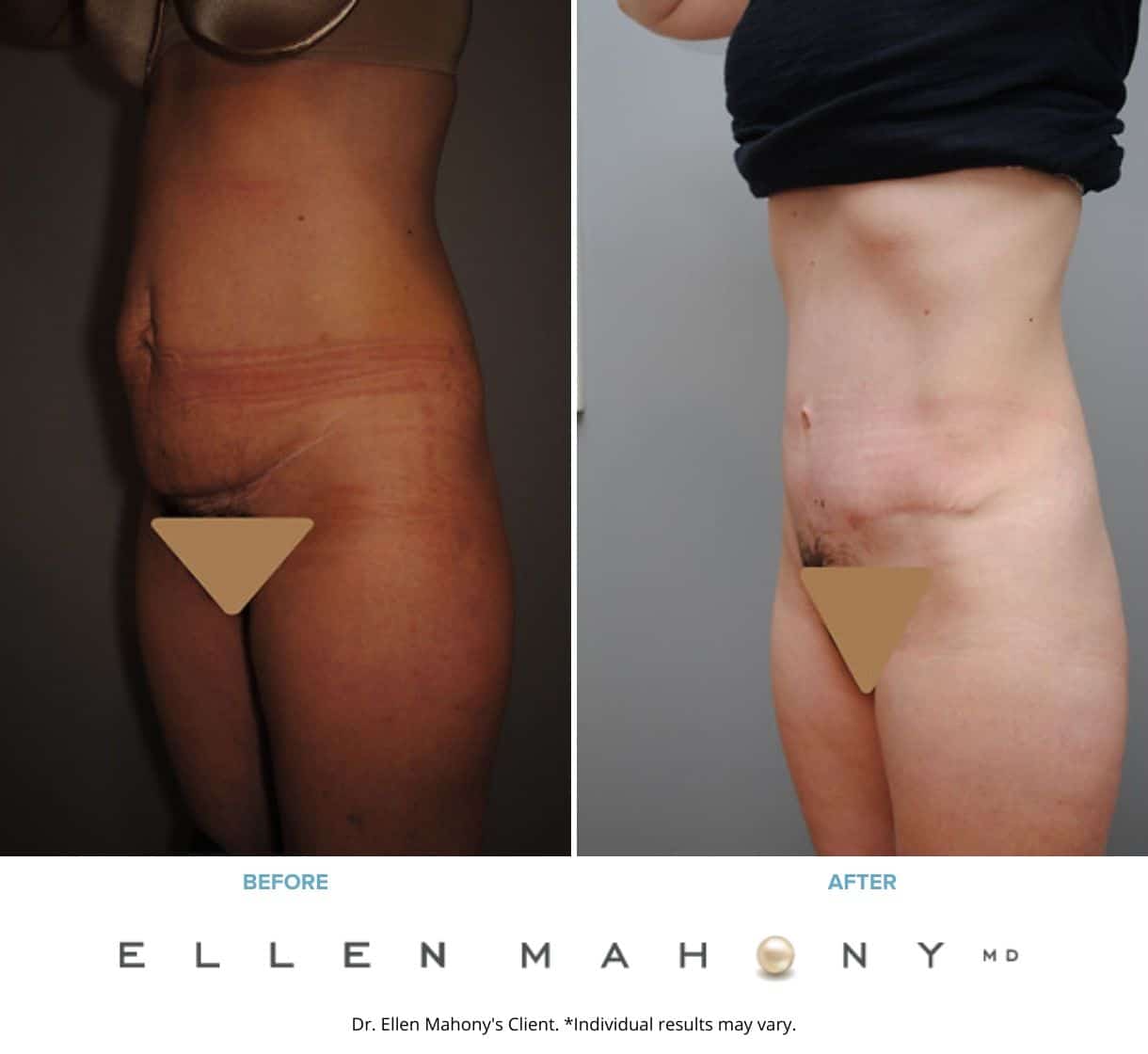 Before and After Image: Case #2393 - left-front-oblique