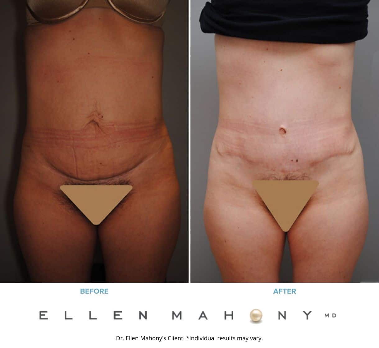 Before and After Image: Case #2393 - front