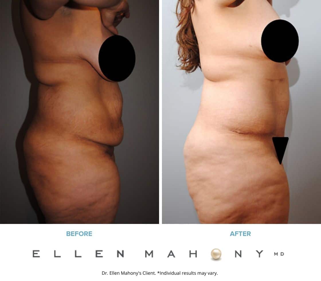 Before and After Image: Case #2400 - right-side