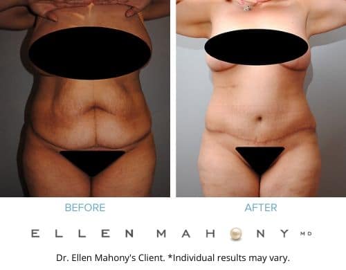 Before and After Image: Case #2400 - front
