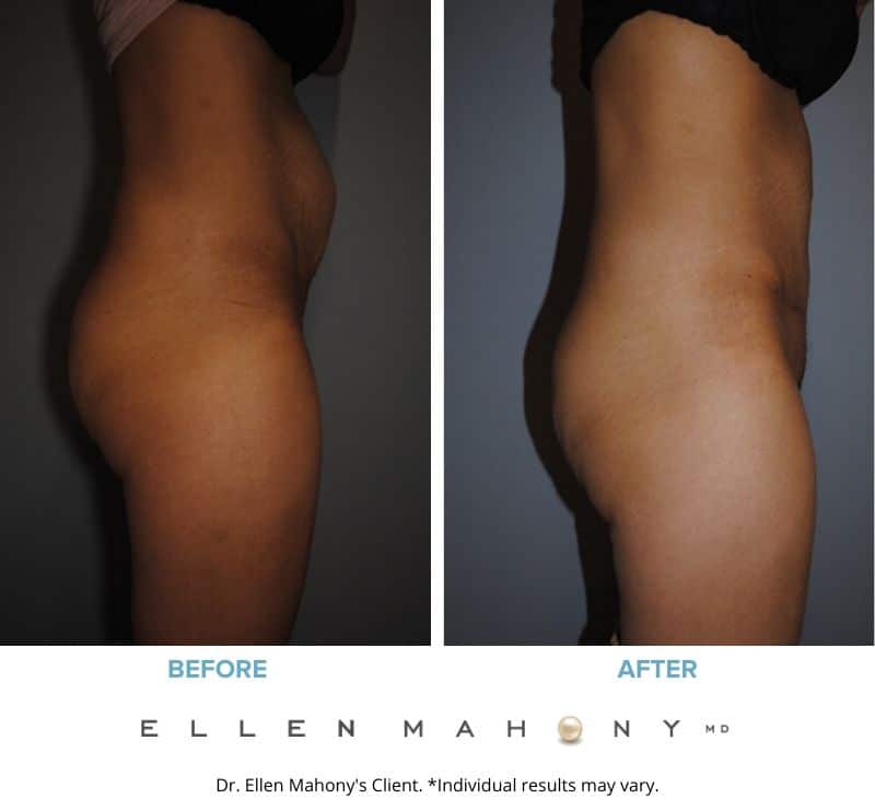 Before and After Image: Case #2407 - right-side