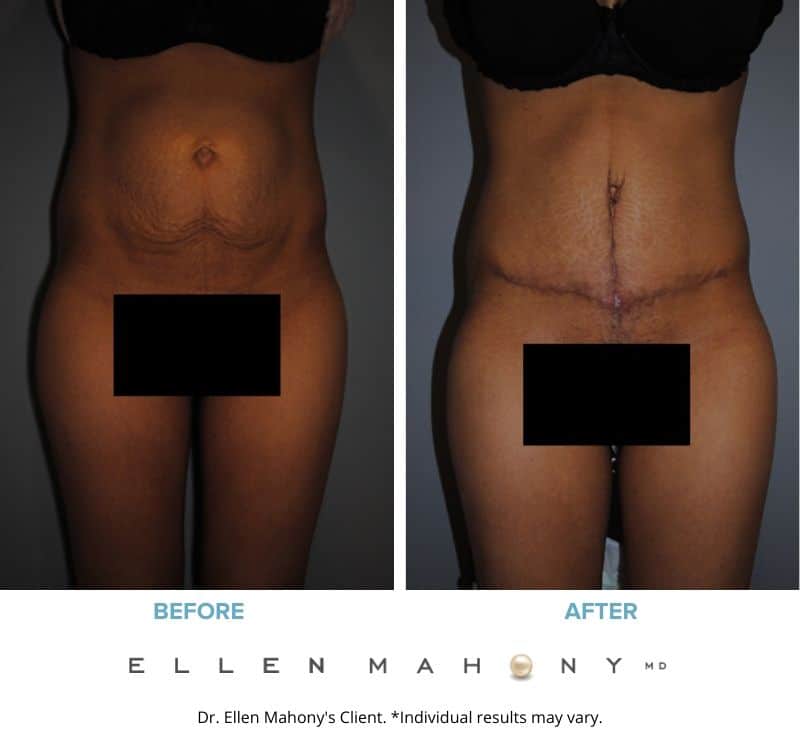 Before and After Image: Case #2407 - front