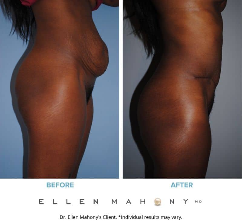 Before and After Image: Case #2416 - right-side