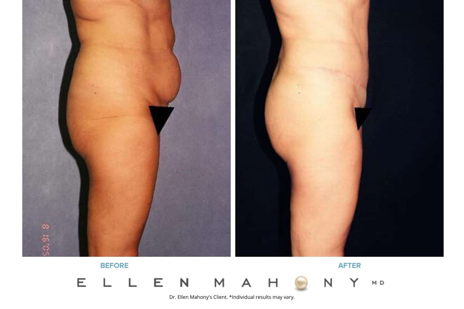 Before and After Image: Case #2426 - right-side