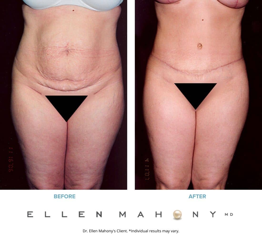 Before and After Image: Case #2431 - front