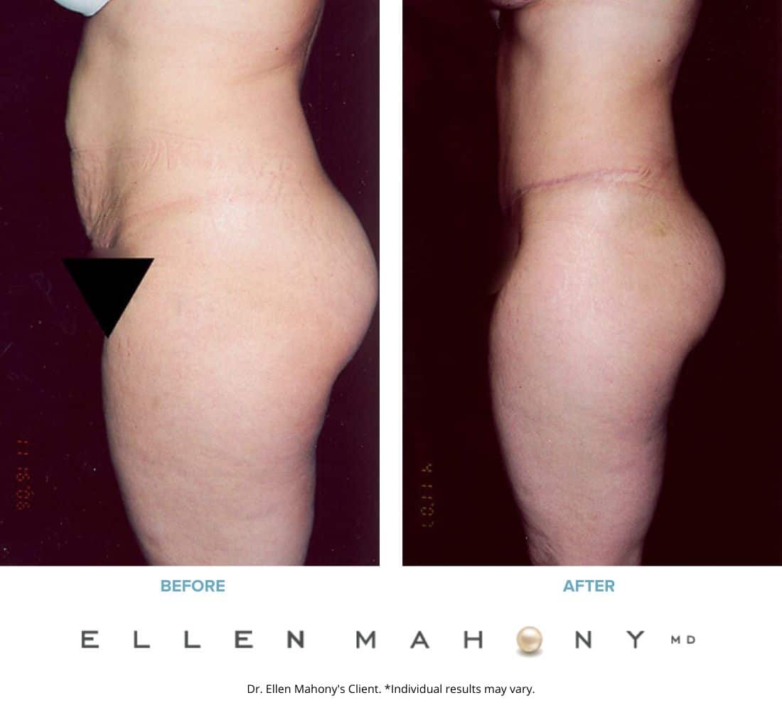 Before and After Image: Case #2431 - left-side