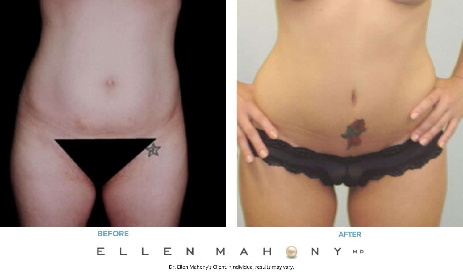 Before and After Image: Case #2474 - front