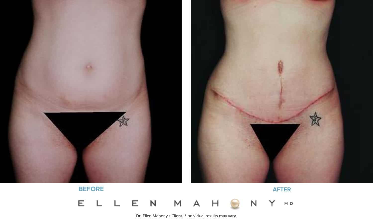 Before and After Image: Case #2474 - front
