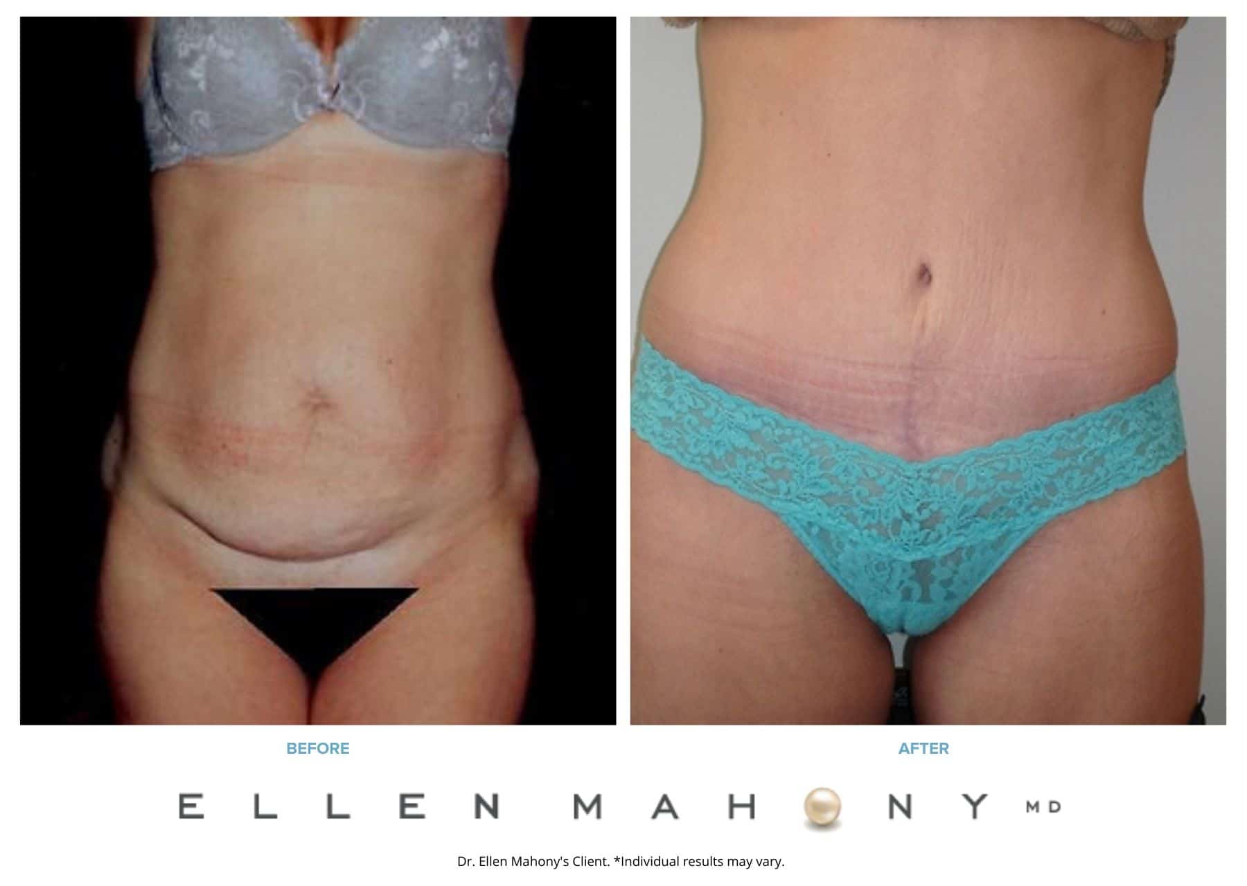 Before and After Image: Case #2493 - front