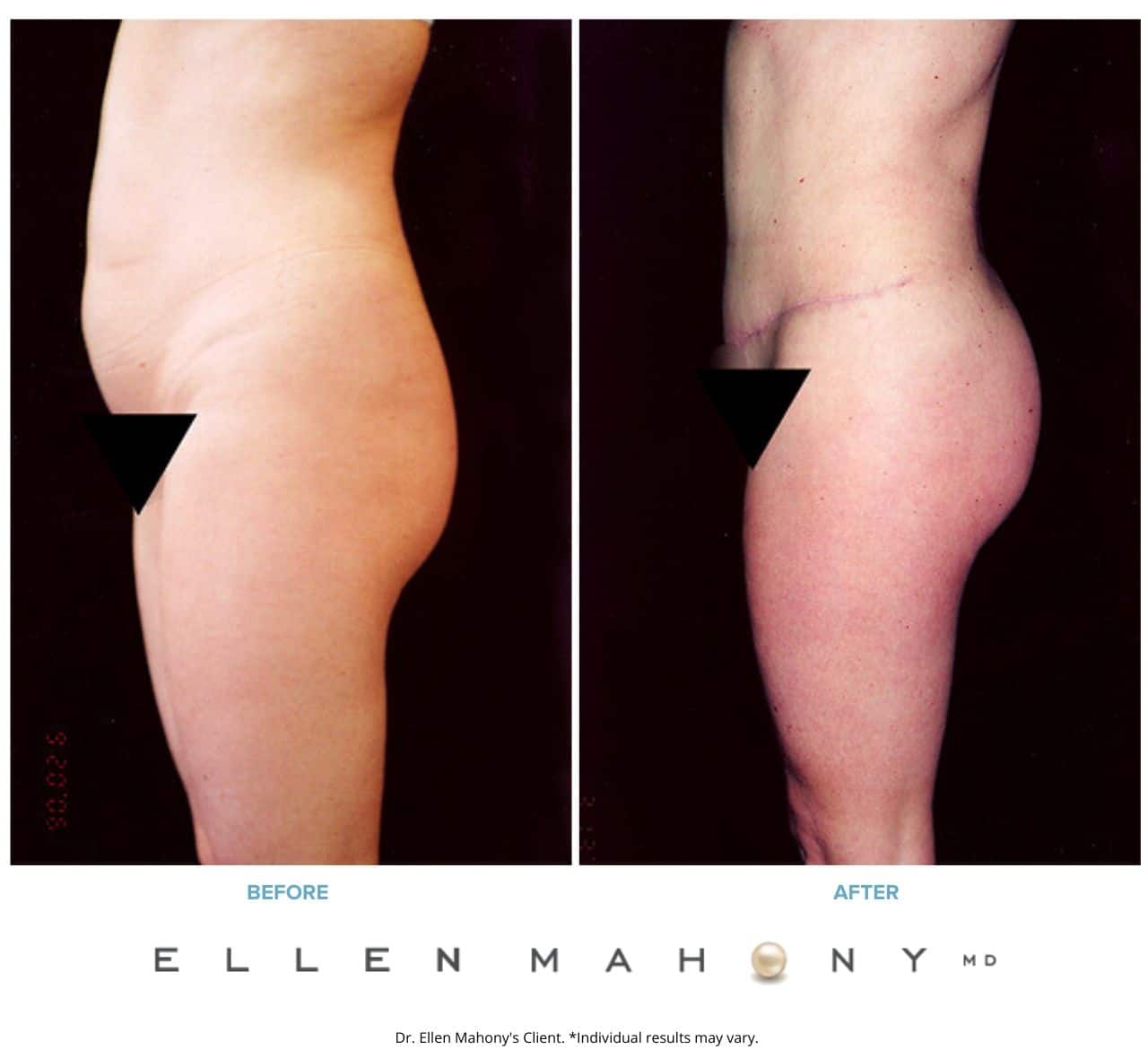Before and After Image: Case #2512 - left-side