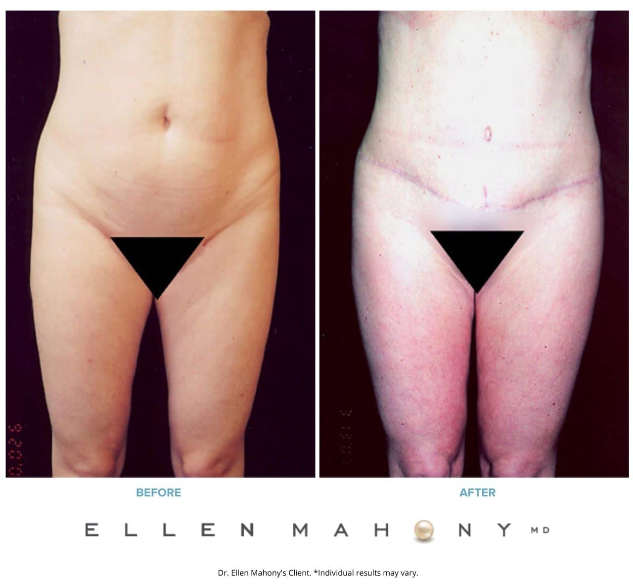 Before and After Image: Case #2512 - front