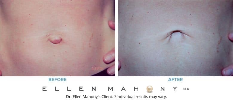 Before and After Image: Case #2534 - front