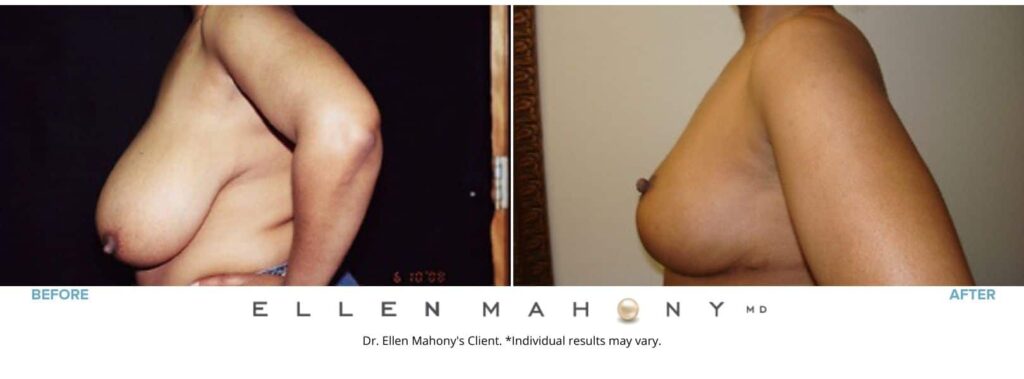 Before and After Image: Case #2606 - left-side