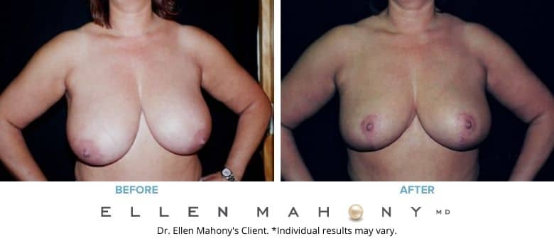 Before and After Image: Case #2622 - front
