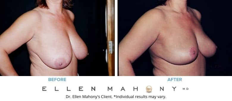 Before and After Image: Case #2622 - right-front-oblique