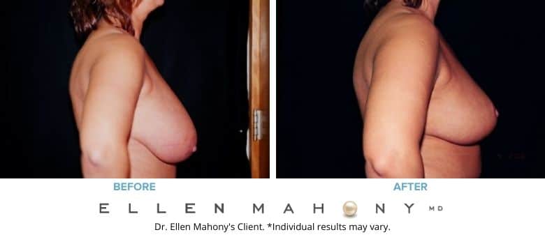 Before and After Image: Case #2622 - right-side